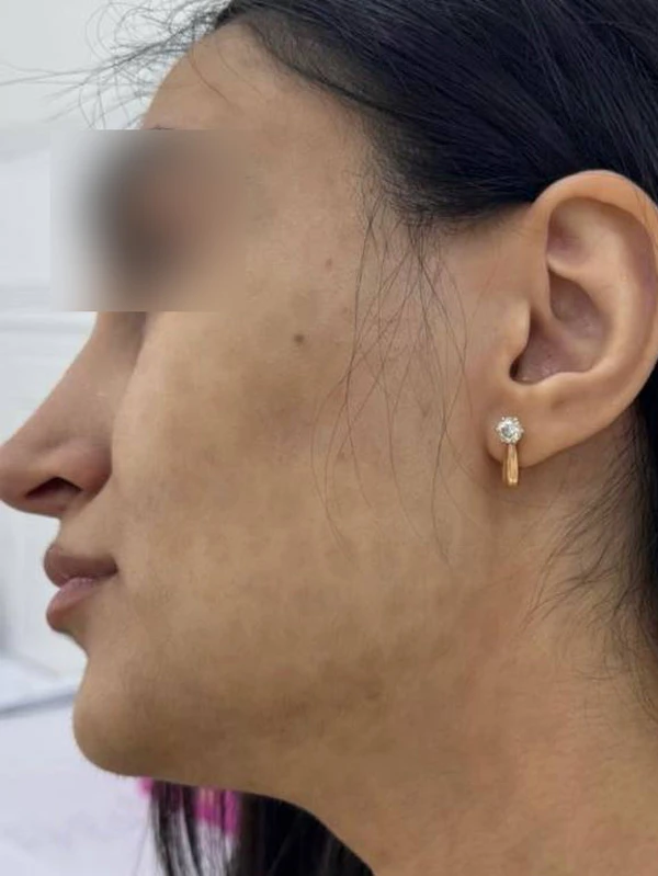 Лазерное лечение гиперпигментации: фото до