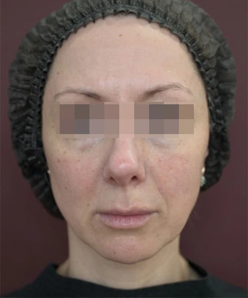 Пациент 2 до процедуры