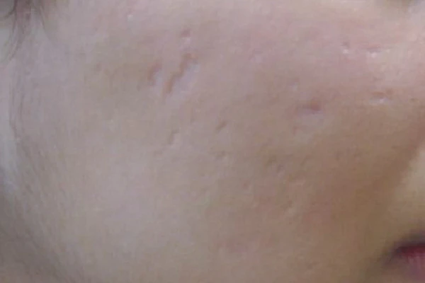 Harmony XL Pro, фото после