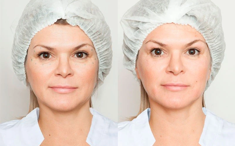 До и после Curacen