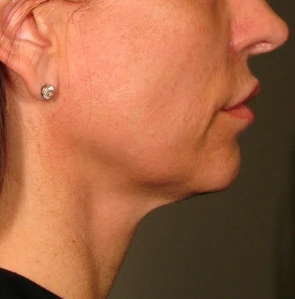 Фото после процедуры Ultherapy