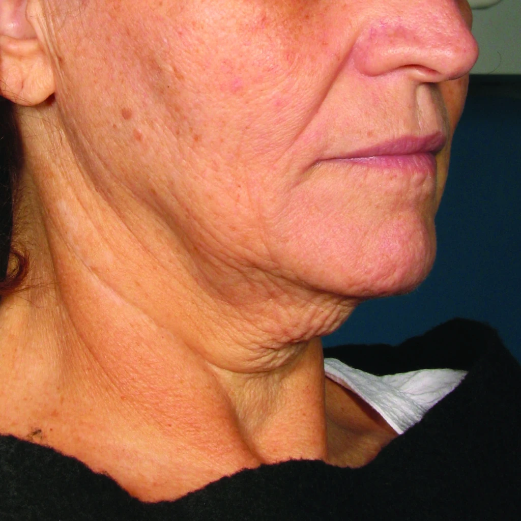 Ultherapy До