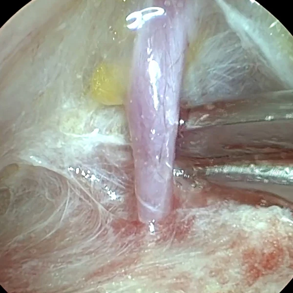 Височный лифтинг филлерами Neauvia