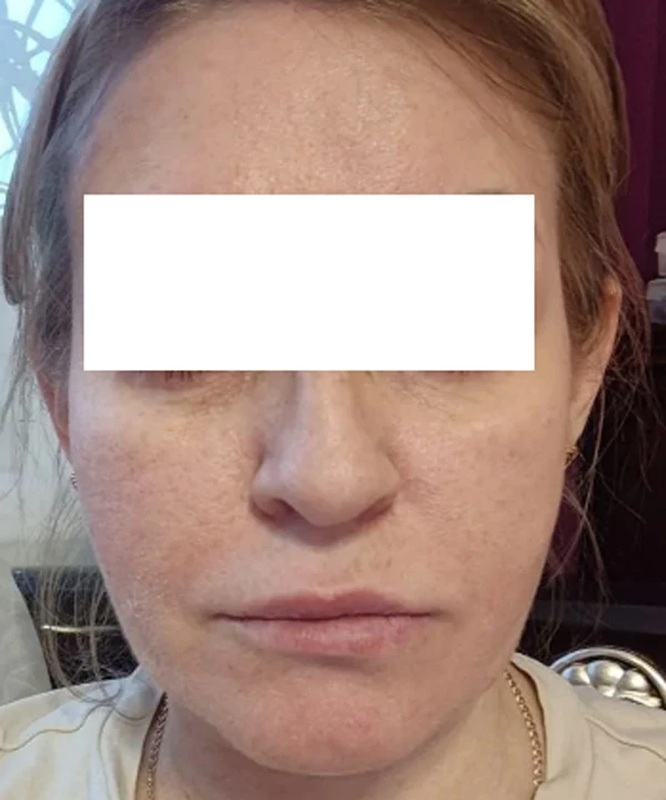 Alma Hybrid, фото после