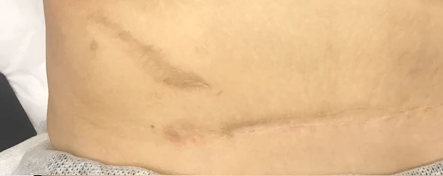 Радиочастотный лифтинг Scarlet RF, фото после