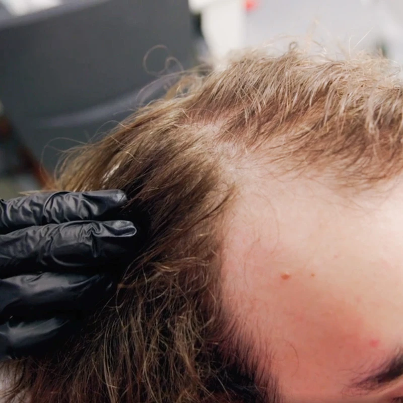 PRP-терапия Cellenis