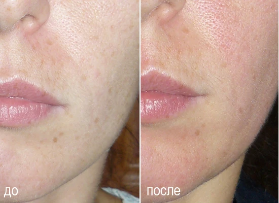 Мезороллер фото до и после