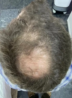 Sylfirm X в лечении алопеции, фото до