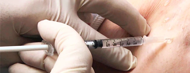 Гипергидроз лечение БТА