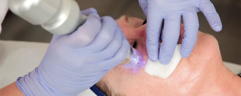 микроигольчатый RF-лифтинг Scarlet RF