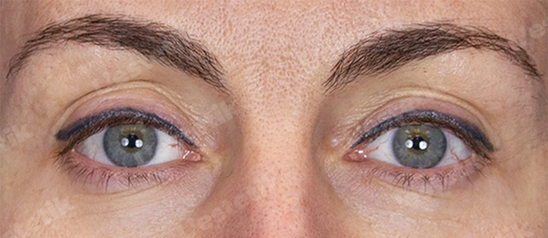 RF-лифтинг Ashley, фото До