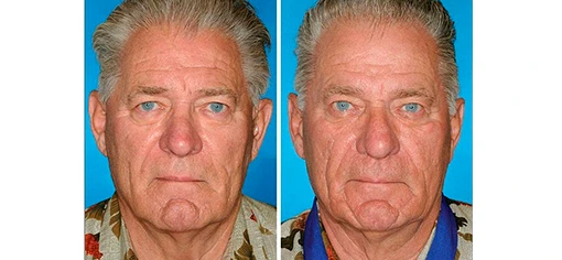  Однояйцевые близнецы