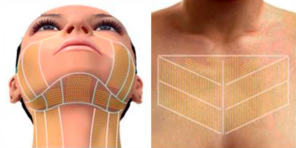 Области обработки MFU-V