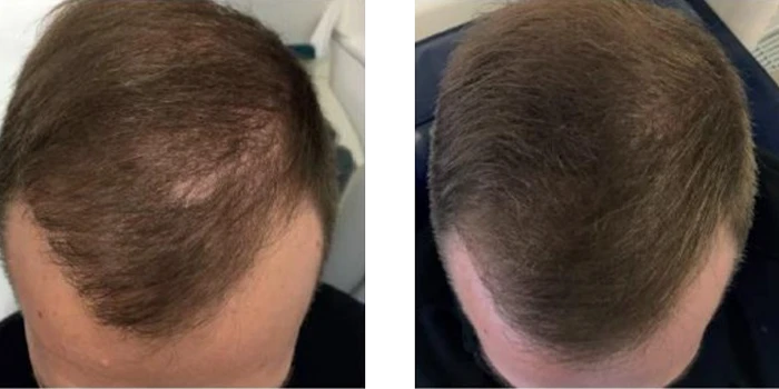 Cellenis® PRP фото до и после