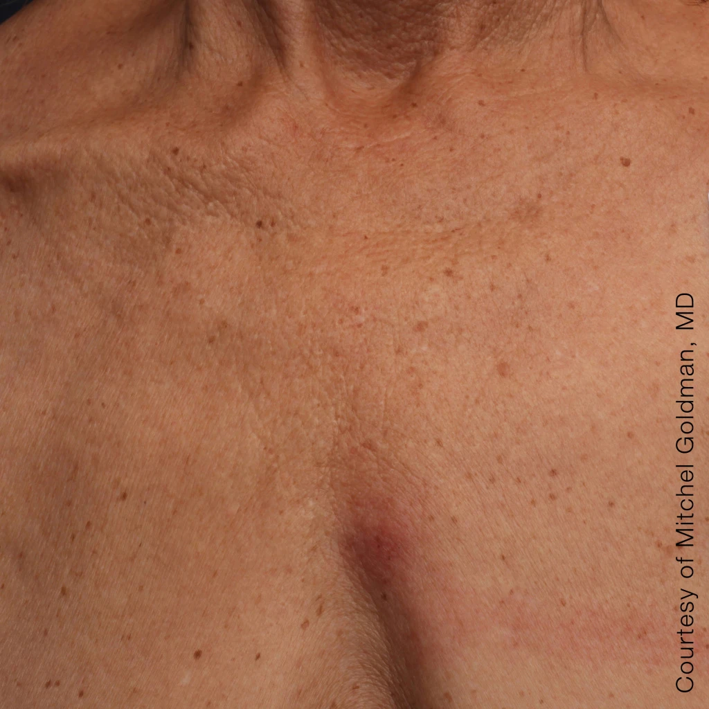 Ultherapy После
