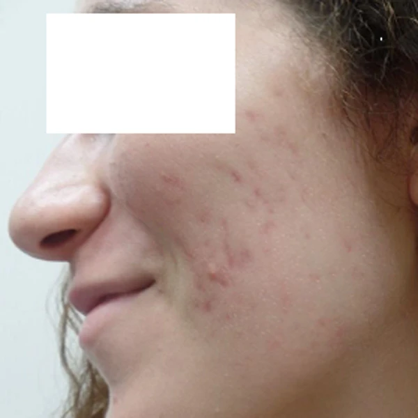 Harmony XL Pro, фото до