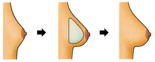 Анатомические импланты