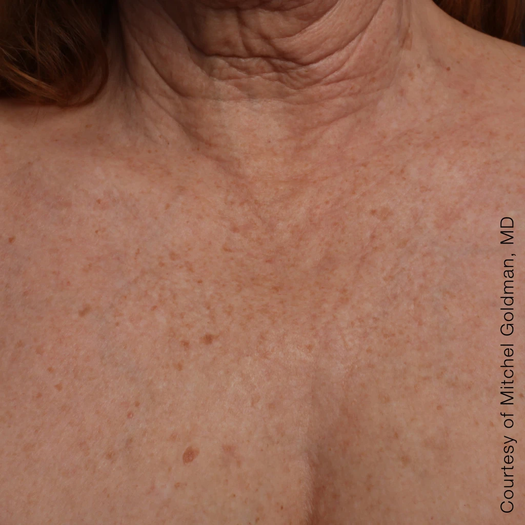 Ultherapy После