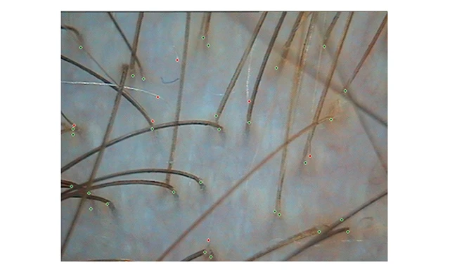 Теменная зона при диффузном выпадении волос 