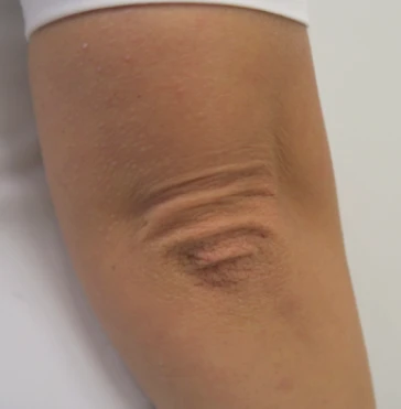 Радиочастотный лифтинг Scarlet RF, фото до