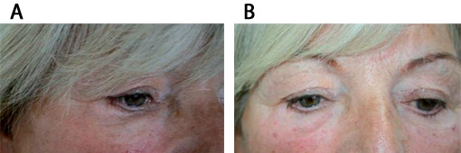 Препараты гиалуронидазы