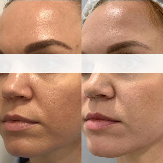 Аппарат INUS. Фото до и после