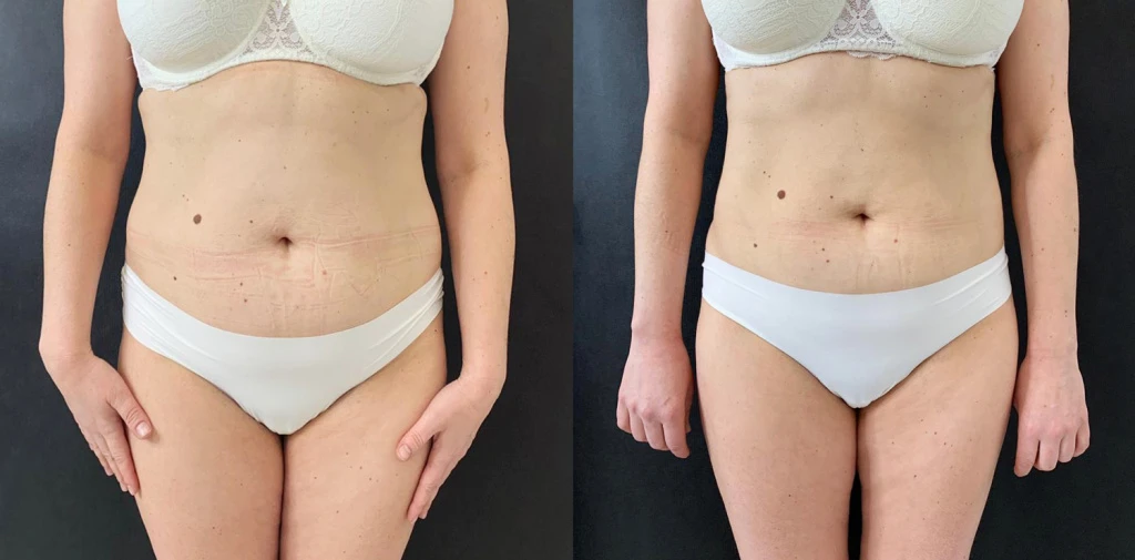 коррекция на аппарате Accent, фото до и после