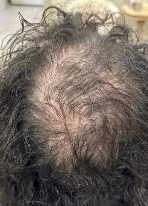 Sylfirm X в лечении алопеции, фото до