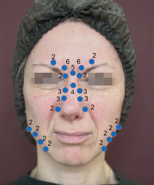 Разметка для инъецирования Ксеомин