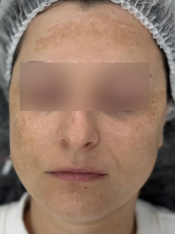 Лазерное лечение гиперпигментации: фото до