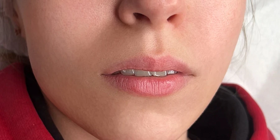 Коррекция губ Stylage Special Lips