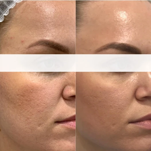 Аппарат INUS. Фото до и после