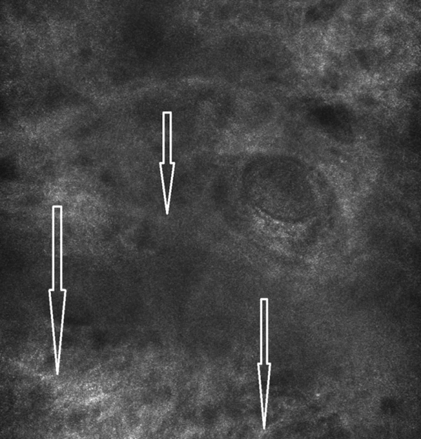 состояние дермы после проведения инъекционного курса АЗТ Jalupro®