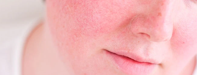 Лечение розацеа