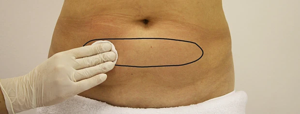 Протокол мезокоррекции локальных жировых отложений