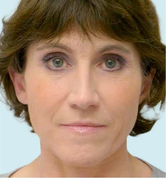 Качество кожи после применения филлера Radiesse®