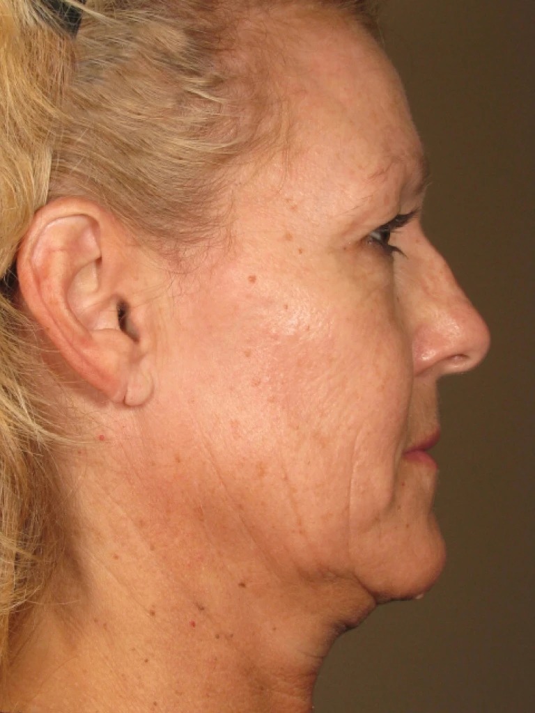 Ultherapy До