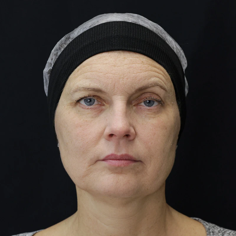 Bioregen Фото до