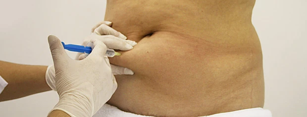 Протокол мезокоррекции локальных жировых отложений