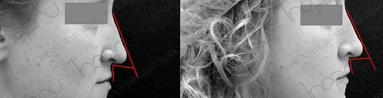 Назолабиальный угол до коррекции и через две недели после