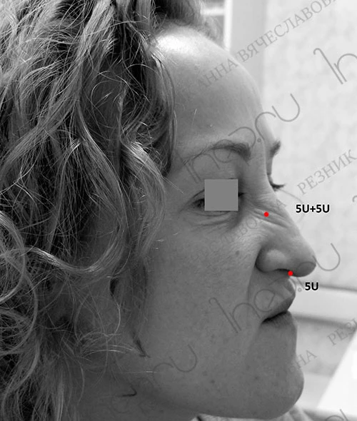 очки и дозы ботулотоксина