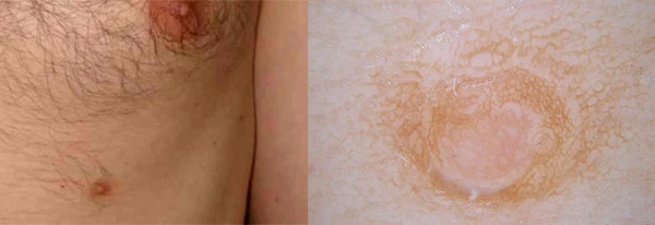 Дерматоскопия