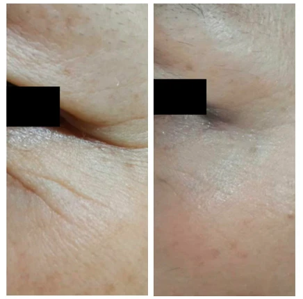 Аппарат INUS. Фото до и после