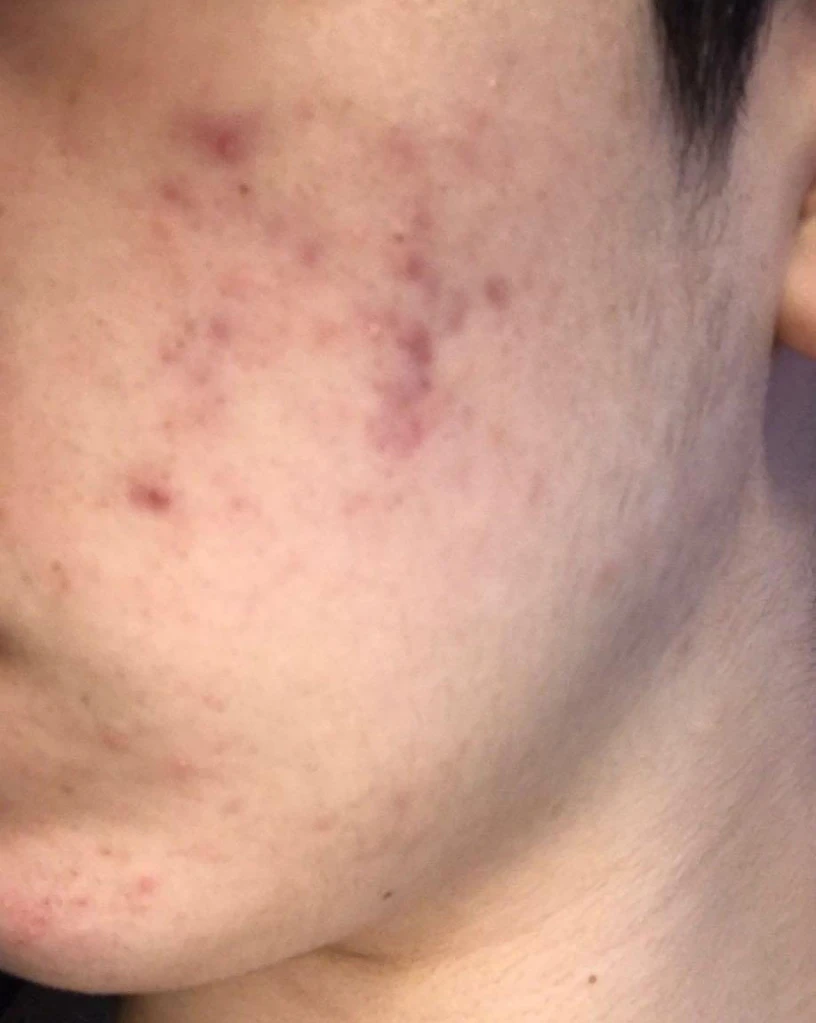 BBL BroadBand Light Acne