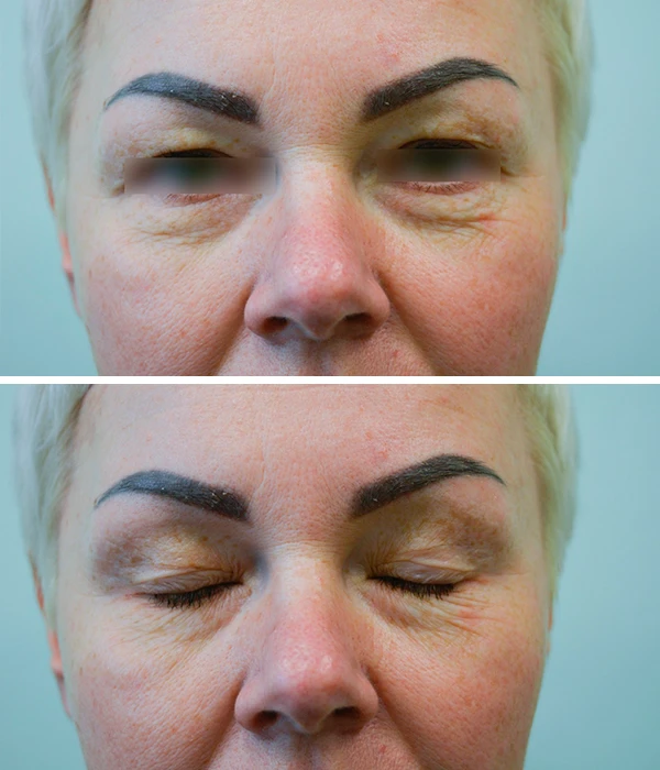 Пластика верхних век: фото до
