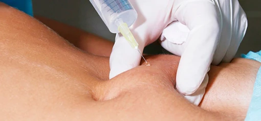 Инъекционный липолиз