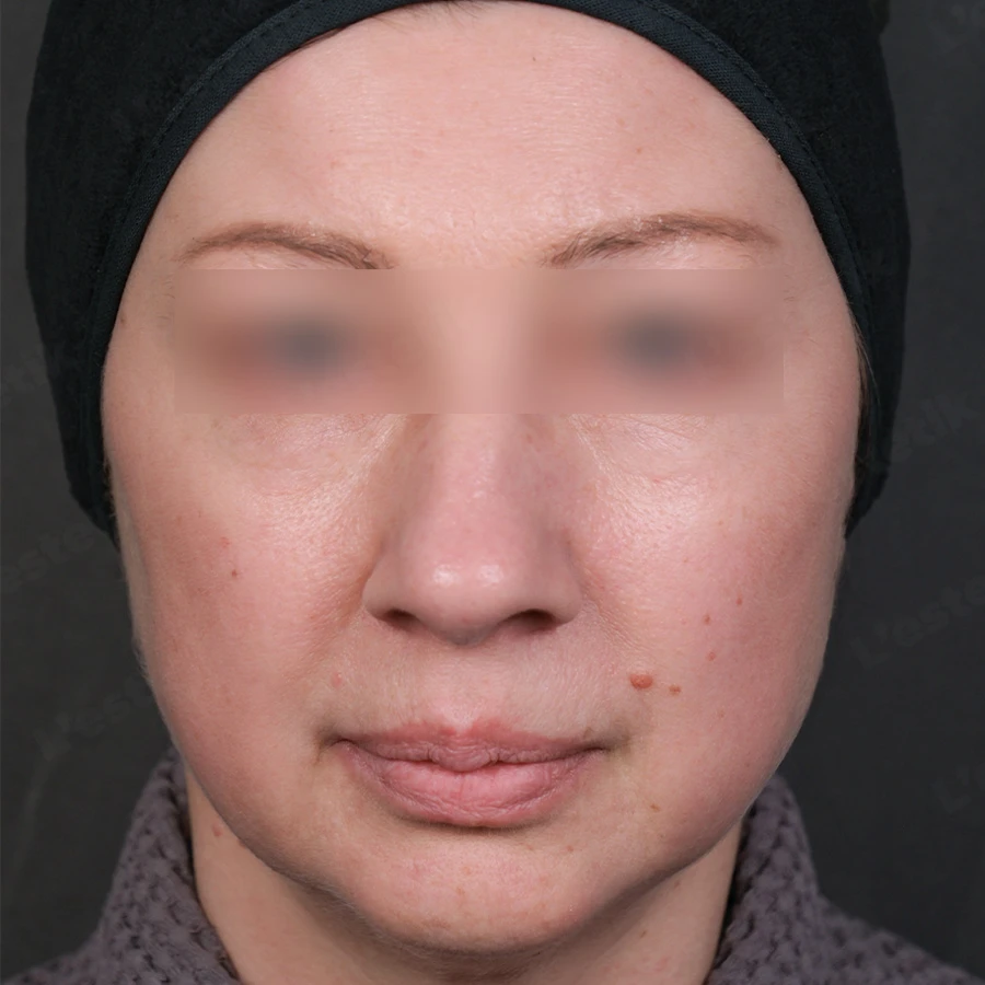 Ashley и Peach Peel PRO: После протокола