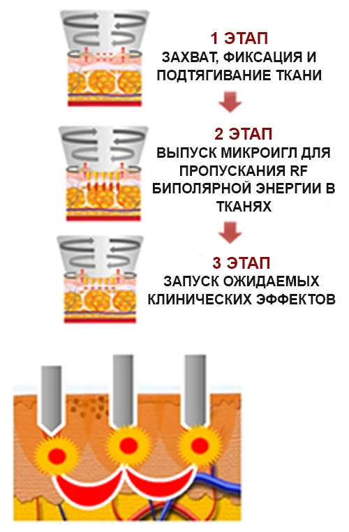 Аппарат INUS, насадки
