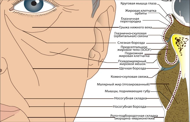  коррекция носослезной борозды, носослезная борозда пластика