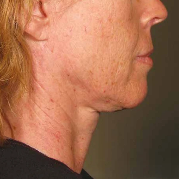 Ulthera System фото до и после